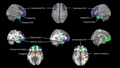 Does an Over-Connected Visual Cortex Undermine Efforts to Stay Sober After Treatment for Alcohol Use Disorder?